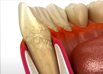 Bryan Johnson's Teeth Gum Attachment