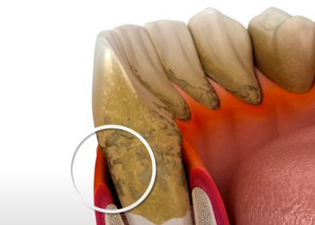 Bryan Johnson's Teeth Pocket Depth